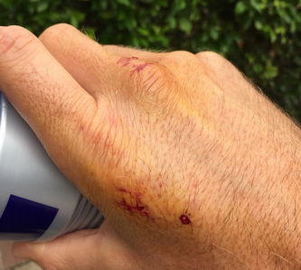 Jamie Whincup's swollen hand after the snake bite